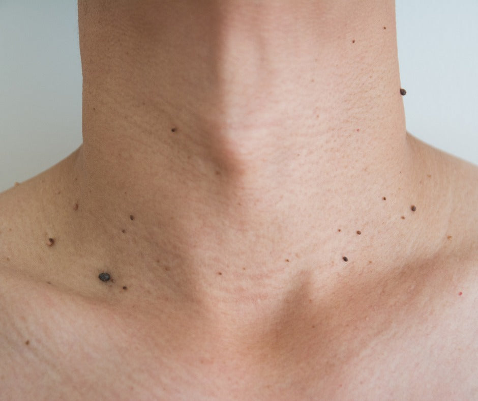 Skin Tag Removal